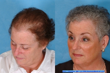Discover The Best Haircuts For Women With Thinning Hair